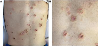 Malignant atrophic papulosis treated with eculizumab and hirudin: a fatal case report and literature review